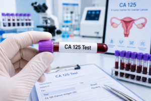 CA 125 Test